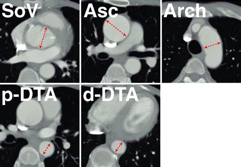 An Example Of Aortic Diameter Measurements At Five Levels The Five