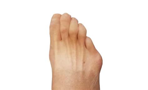 Tailor S Bunion Kc Foot Care Thomas Bembynista Dpm