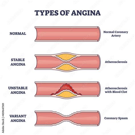 Types of angina as chest pain and heart problem explanation outline ...