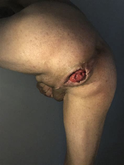 My Anal Prolapse Is Changing Incredibly 11 Pics XHamster
