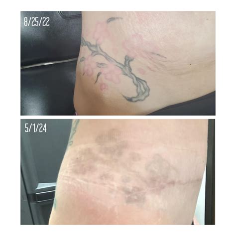 Discuss Tattoo Removal