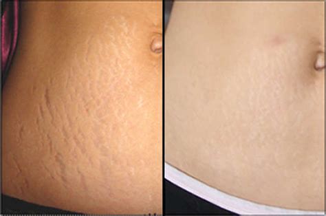 stretch mark removal sliq clinic