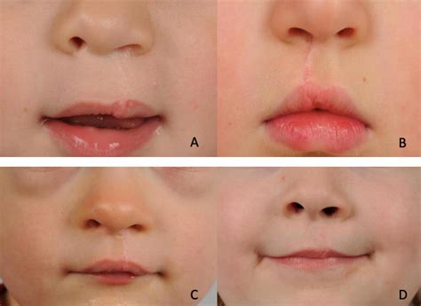 The Role Of Scar Massage In Cleft Lip Surgery Published In