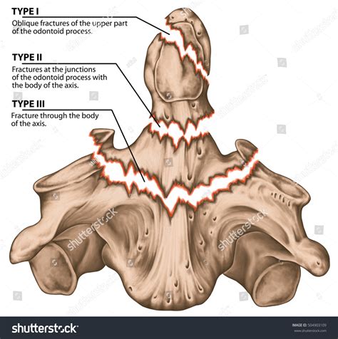 Odontoid Photos Images And Pictures Shutterstock