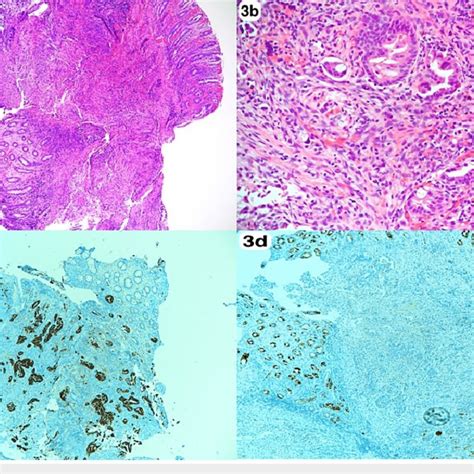 Histopathology Of Colonic Lesion A B Sigmoid Colon Biopsy Colonic Download Scientific