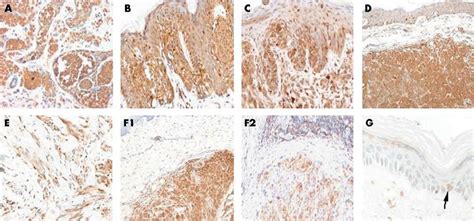 Extracellular signal regulated kinase 1/2 expression in different types ...