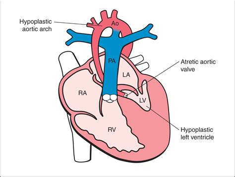 Hypoplastic Left Heart Syndrome And Critical Aortic Stenosis Obgyn Key