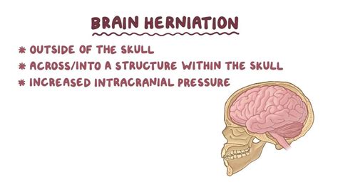 Uncal Herniation: What Is It, Causes, and More | Osmosis