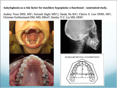 Tongue Tie Functional Ankyloglossia Zaghimd