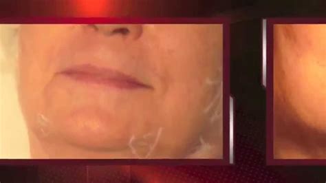 lifting du visage - lifting du cou - rajeunissement du visage - Docteur ...