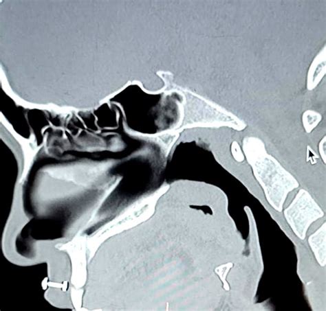 My Medusa Labret On Ct Scan Rbodymods