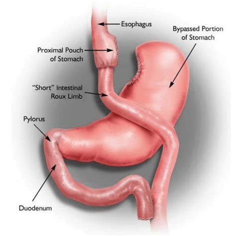 A Prof Jaber Single Anastomosis Stomach Ileal Bypass With Sleeve