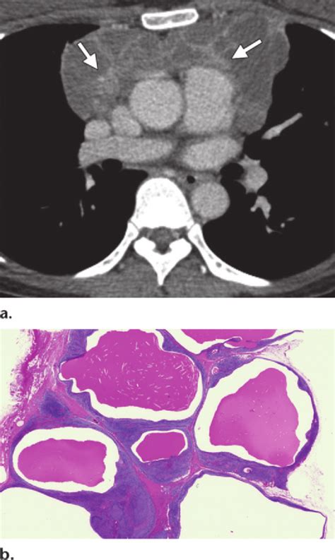 Multilocular Thymic Cyst In A 43 Year Old Woman With Primary Sjögren