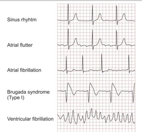 Figure 2 From ARRHYTHMIA S TYPES PATHOPHYSIOLOGY AND THERAPY A