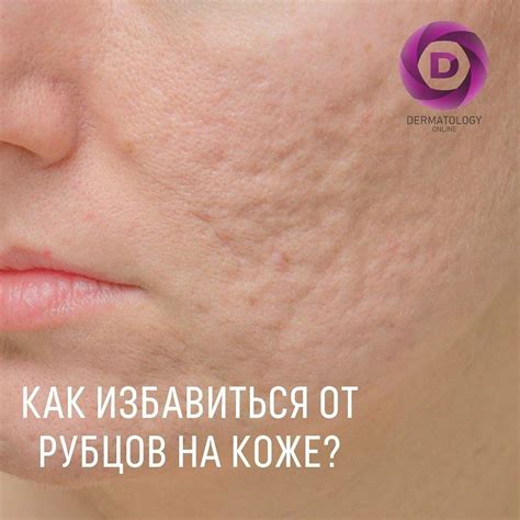 Рубцы на коже, как избавиться, виды, лечение, консультация