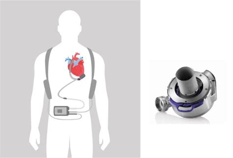 What Does An Lvad Look Like A Friends Guide