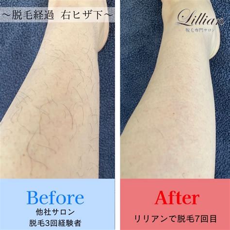 脱毛経過写真（beforeafter） Lillian（リリアン） 周南・米子・出雲・長崎・宮崎・高知・徳島の脱毛ならlillian