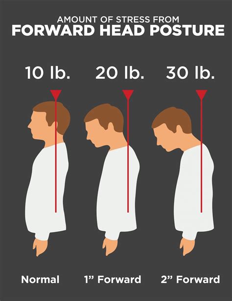 Forward Head Posture Symptoms