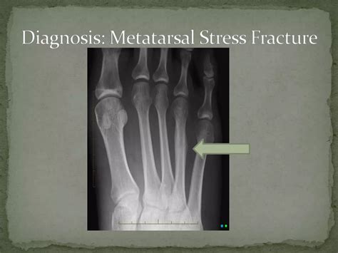 Metatarsal Stress Fracture | PPTX