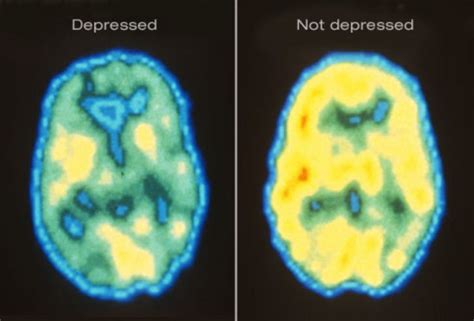 wondered   depression   brain   pattern