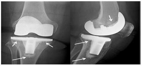 Biomaterials as Implants in the Orthopedic Field for Regenerative