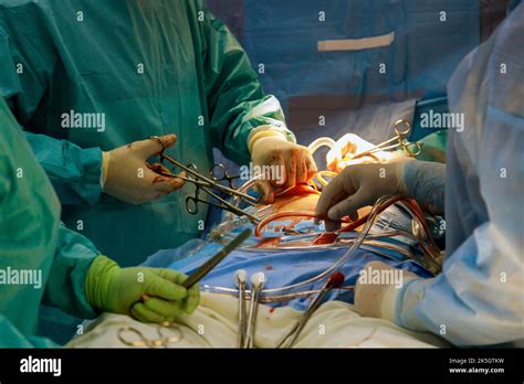 Procedure of coronary artery bypass graft CABG for the operation a heart due to coronary heart ...