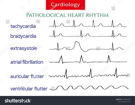 3562 Ecg Arrhythmia Images Stock Photos And Vectors Shutterstock