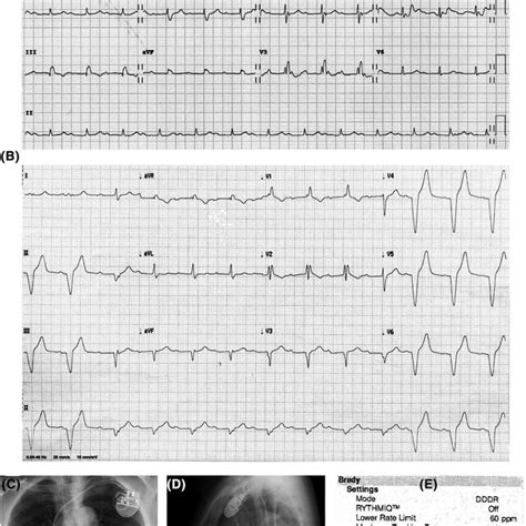 A Baseline 12‐lead Electrocardiogram And Lead Ii Rhythm Strip B