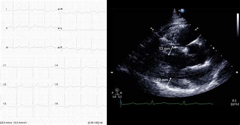 Electrocardiography For The Detection Of Left Ventricular Hypertrophy