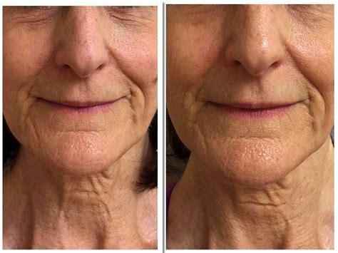 Milf Facial Before And After Telegraph