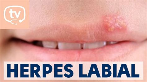 El Herpes Labial Qu Es Causas Y Tratamiento Youtube