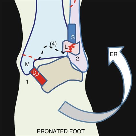 An Ser Iv Bimalleolar Fracture A B Was Fixed Using Three Partially