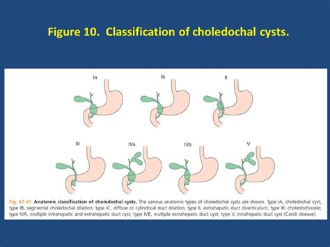 Gallstones And Hepatic Cysts The Clinical Advisor