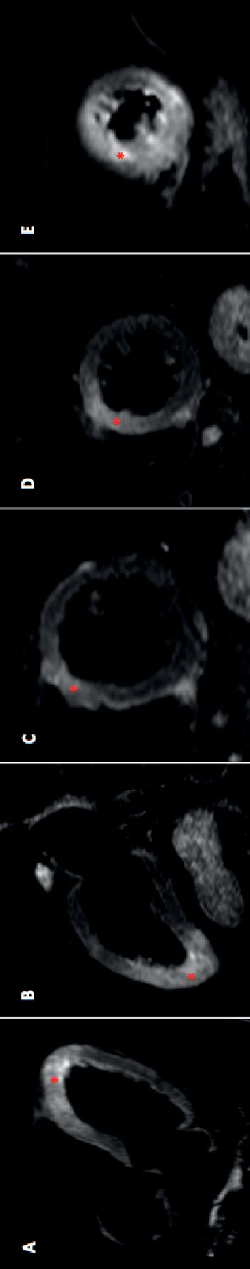 T2 Weighted Short Tau Inversion Recovery Imaging Showing Myocardial