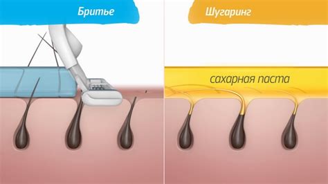 Эпиляция зоны глубокого бикини (39 фото): интимная депиляция, удаление ...