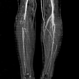 Peripheral Angiogram – Hamilton Cardiology Associates