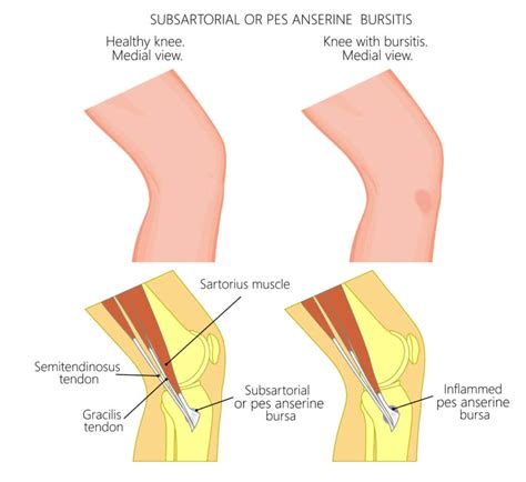 Pes Anserine Bursitis Pes Anserine Bursitis Exercises