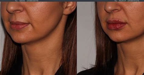More Volume Doesnt Mean The Often Feared Duck Lips”👄 Experience Is