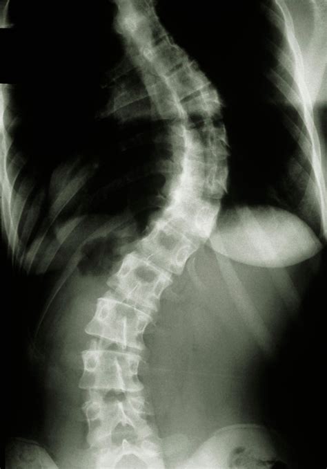 Image:Scoliosis (Spinal Radiograph)-MSD Manual Professional Edition