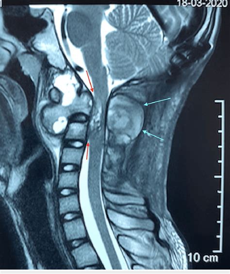 Sagittal Mri Of The Cervical Spine After Surgical Excision Of C2