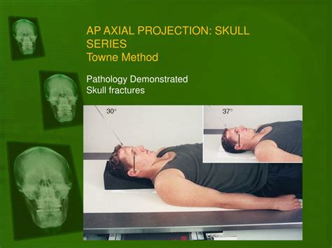 Ppt Positioning Of The Skull Powerpoint Presentation Free Download Id 4499009