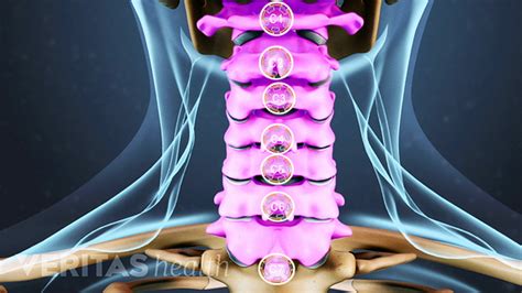 A Visual Guide To Cervical Facet Osteoarthritis