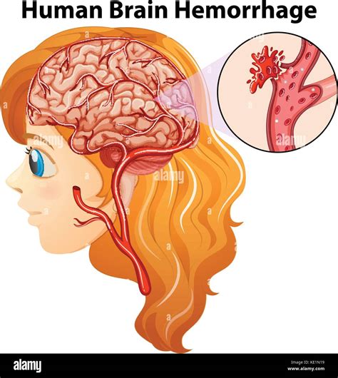 Diagram Showing Human Brain Hemorrhage Illustration Stock Vector Image