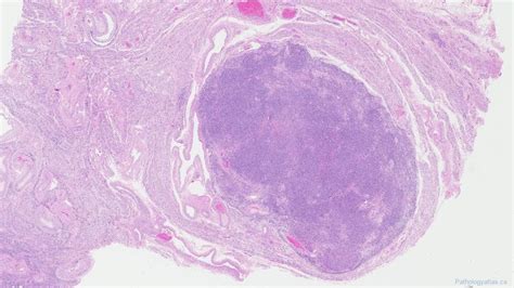 Leiomyoma of the uterus | Ottawa Atlas of Pathology