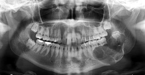 Keratocystic Odontogenic Tumors Clinical And Molecular Features Intechopen