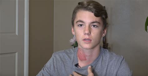 Hot Water Challenge Dangerous Prank Leaves Another Sleeping Teen With Severe Burns Ibtimes Uk