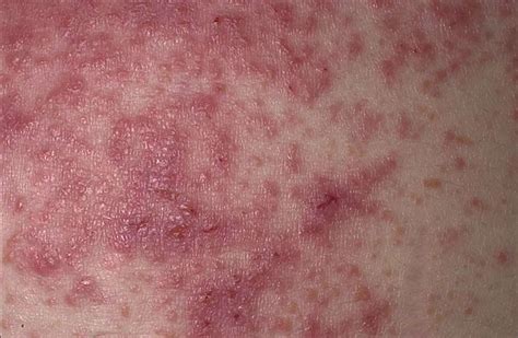 Dermatitis Herpetiformis Celiac Disease Rash Photos