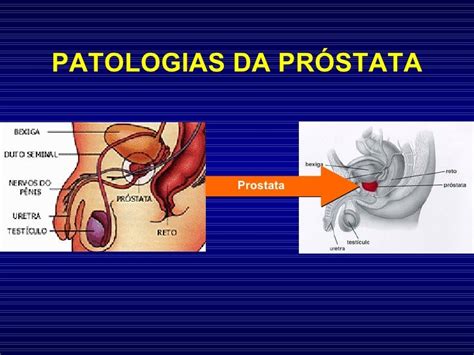 Onde Fica Localizada A Prostata - A Patologia Da Prostata