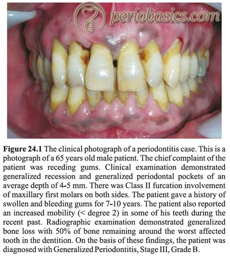 Periodontitis Clinical Presentation Diagnostic Criteria And Treatment