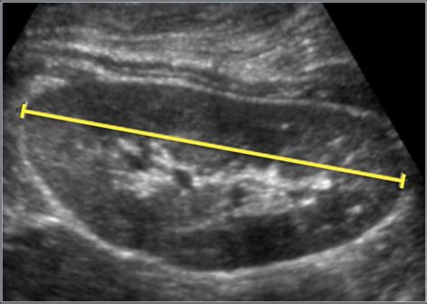 Normal Kidney Ultrasound